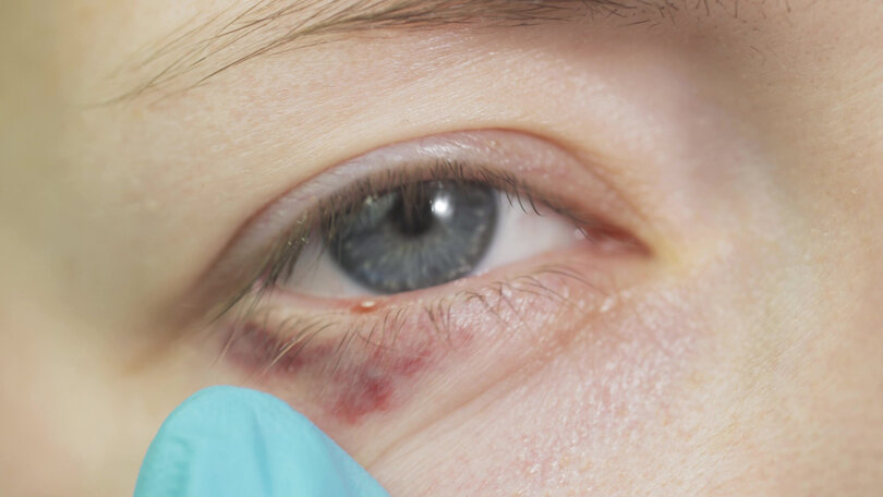 Psoriasis on eyelids and other sensitive areas can be challenging to deal with