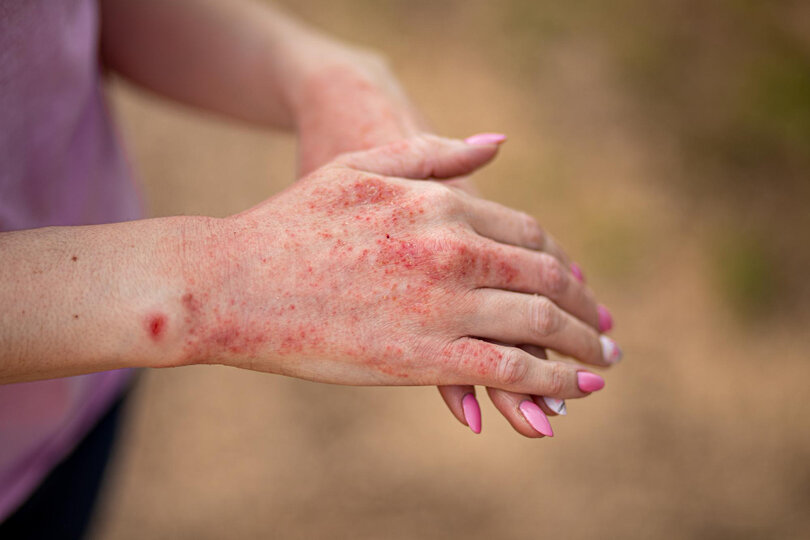 Eczema and psoriasis are examples of psychosomatic skin problems