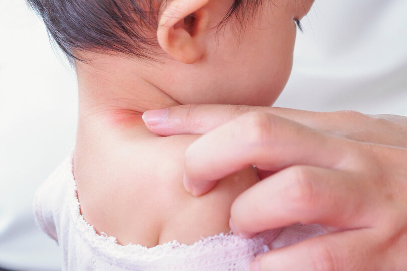 Eczema can affect even babies