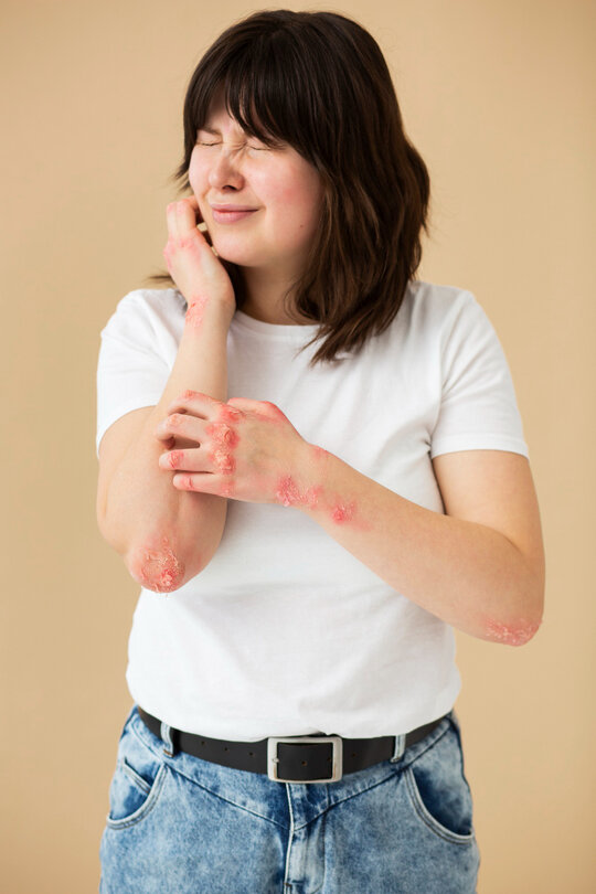 Psoriasis is a common chronic skin condition