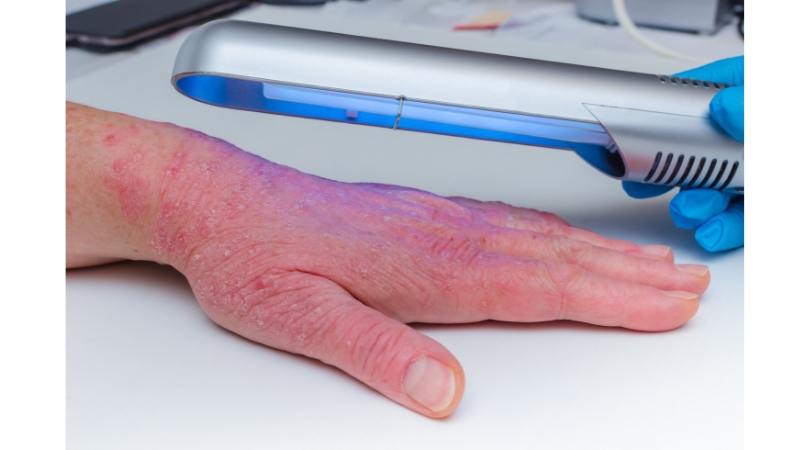 Fig. 1. Phototherapy for hands with psoriasis
