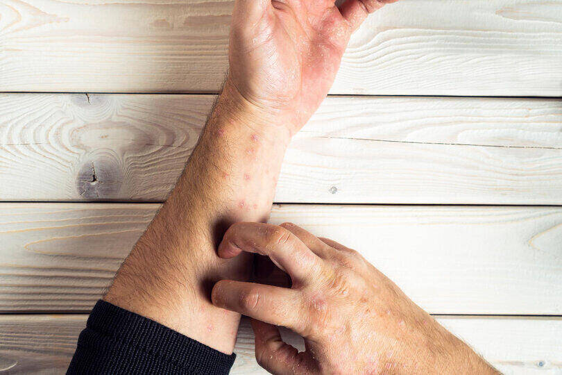 Psoriasis in elderly can lead to certain complications
