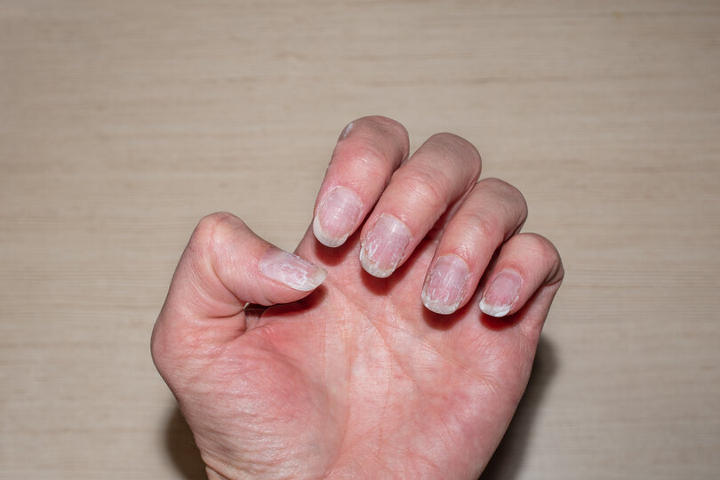 Close- up of bitten and brittle nails without manicure. Overgrown cuticle fingernails and tainted nail plate. Cuticle overgrown nails and damaged nail plate. Concept of nail care and health.