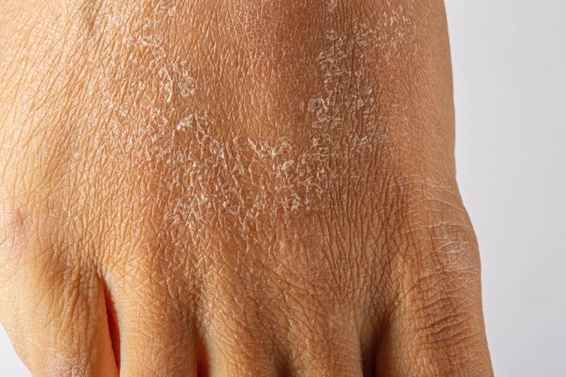 Skin dryness can trigger chronic skin problems