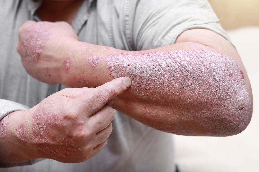 Male arm with severe psoriasis