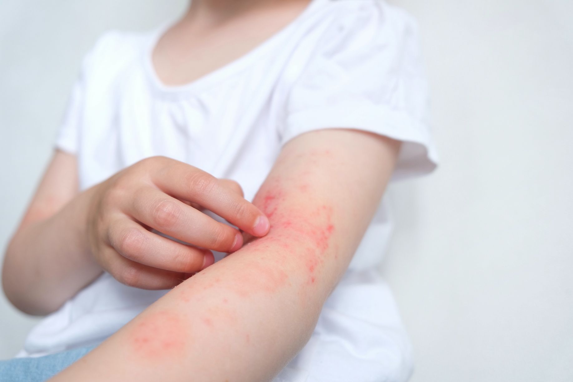 A child scratches atopic skin